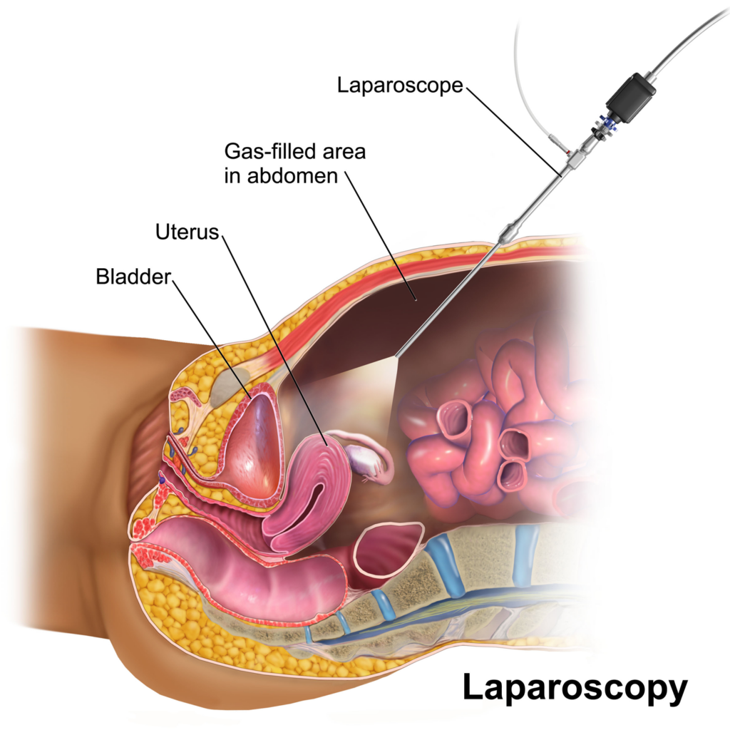 blausen 0602 laparoscopy 02