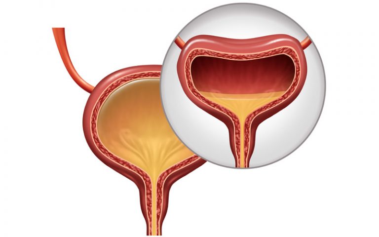 overactive bladder 768x480